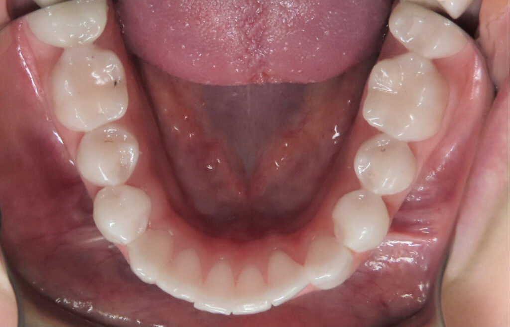 bottom teeth