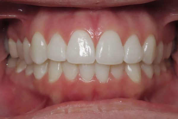 center teeth picture center teeth picture - orthodontist shelley