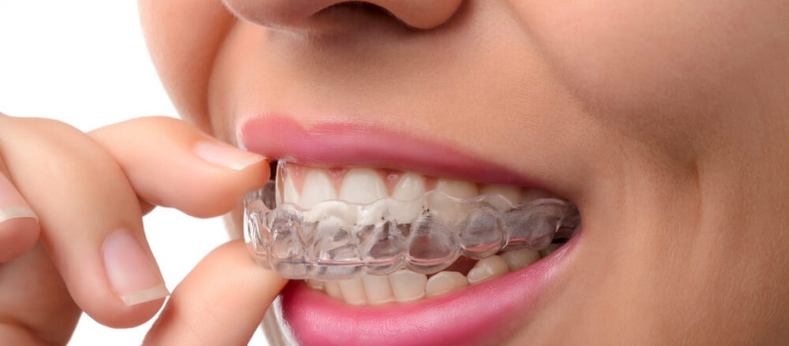 Invisalign - shelley orthodontics
