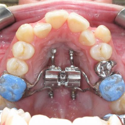 Madelyne-Beck—04—Occlusal-Upper-(1) Madelyne-Beck---04---Occlusal-Upper-(1)
