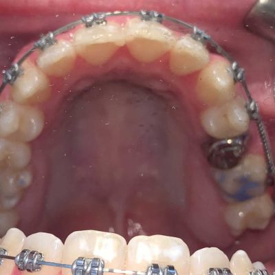 Braces - pocatello orthodontist