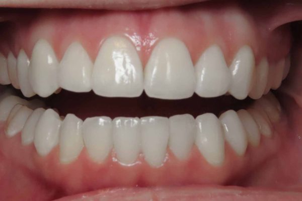 picture of full mouth restoration - mccord orthodontics