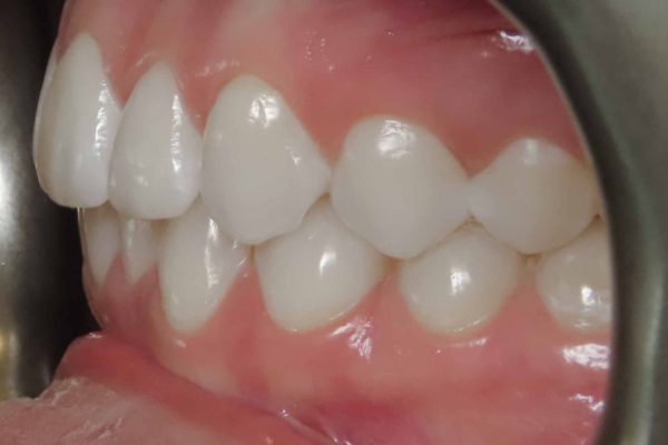 buccal left buccal left