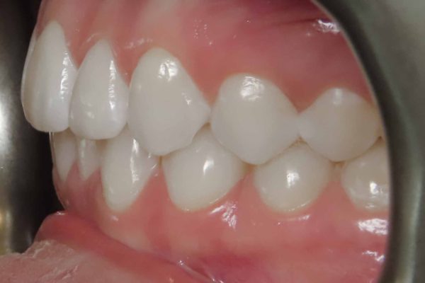 picture of left buccal - pocatello orthodontics