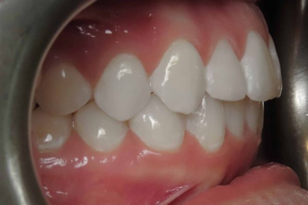 buccal right buccal right